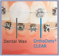 Orthodots - brace wax alternative.
